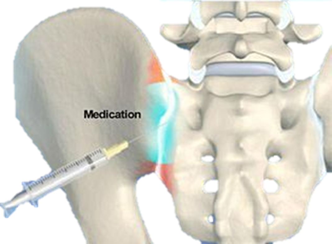 Sacroiliac Joint Pain Injection