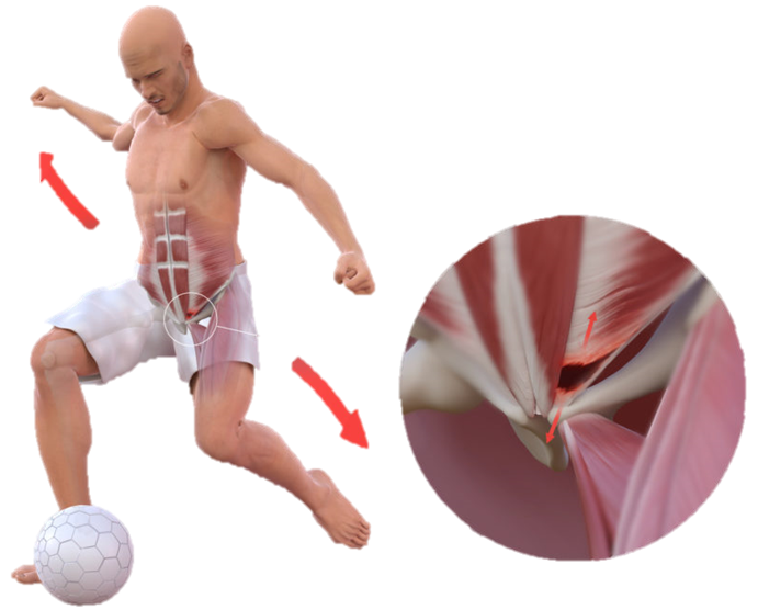 Sports Hernia Rehab On The Road